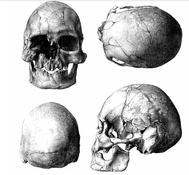 A sketch of a damaged human skull with four different views of the same skull. 